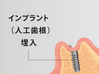 インプラント（人工歯根）埋入手術