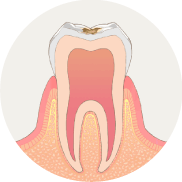 歯の表面に虫歯ができます