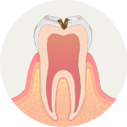 虫歯が神経に近くなり、冷たいものがしみます