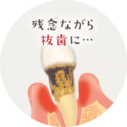 歯槽骨で歯を支えられなくなります