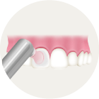 歯の表面をツルツルに仕上げ磨き
